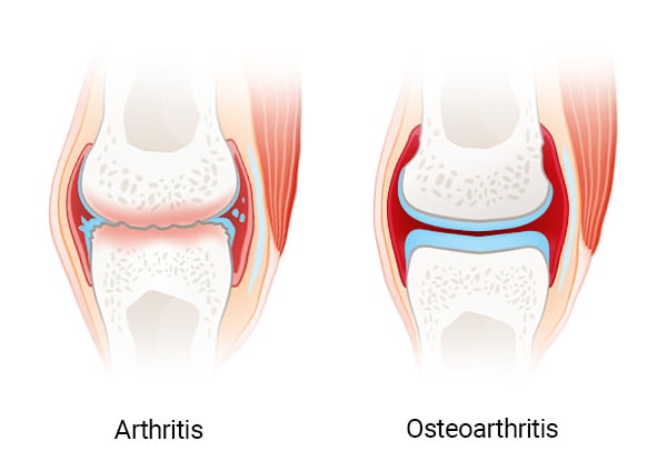 Arthritis vs Osteoarthritis