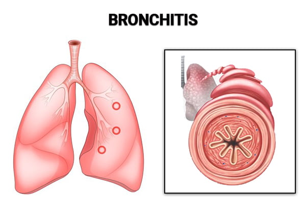 Symptoms Of Bronchitis