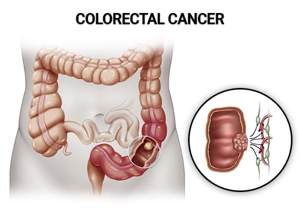 Colorectal Cancer