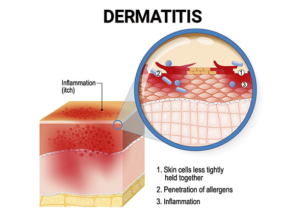 Anatomy of Dermatitis