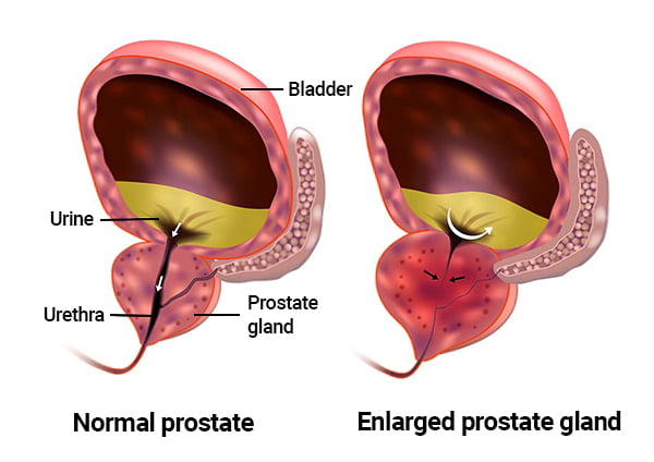 Enlarged prostate gland