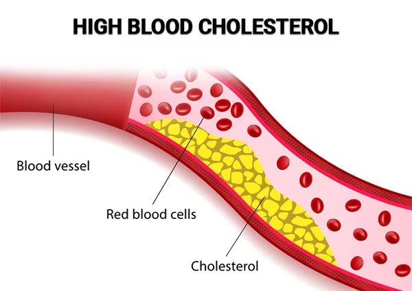 High Cholesterol Treatment NYC High Triglycerides Specialists Midtown UES