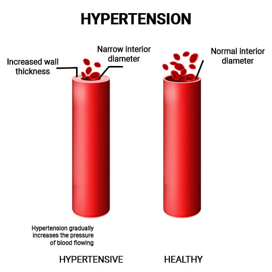 Hypertension