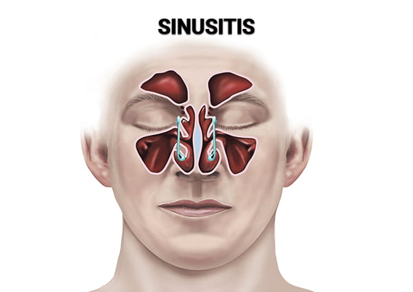 Sinusitis