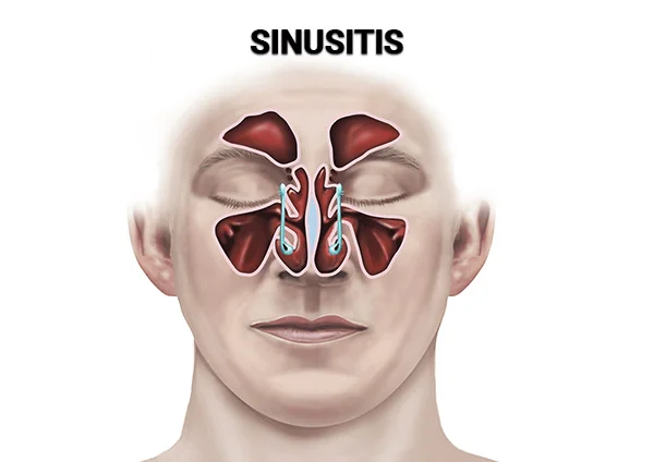 Sinusitis