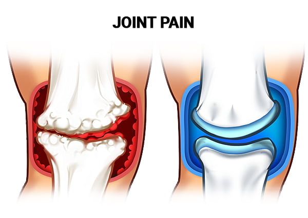 Joint Pain